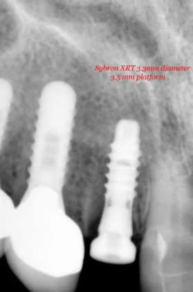 SybronPro XRT HEX (3.5)